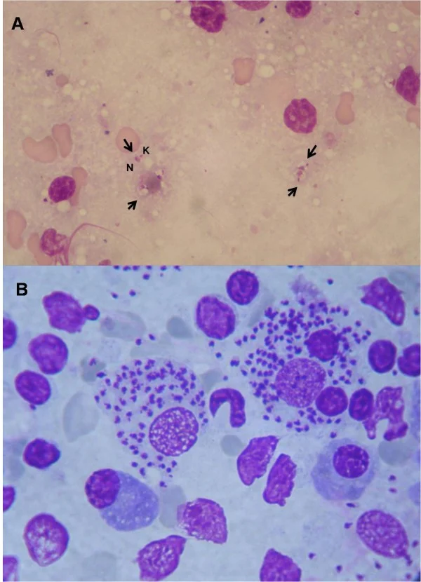 Two microscopic images of lymph-node aspirates showing a few free and many intracellular and extracellular purple-stained Leishmania amastigotes